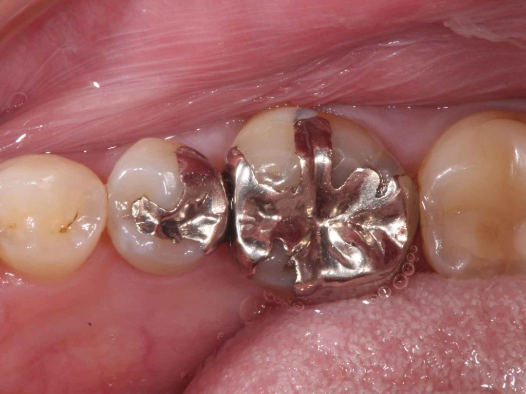 術前写真：右下４番目と５番目の歯に金属の被せ物が入っている
