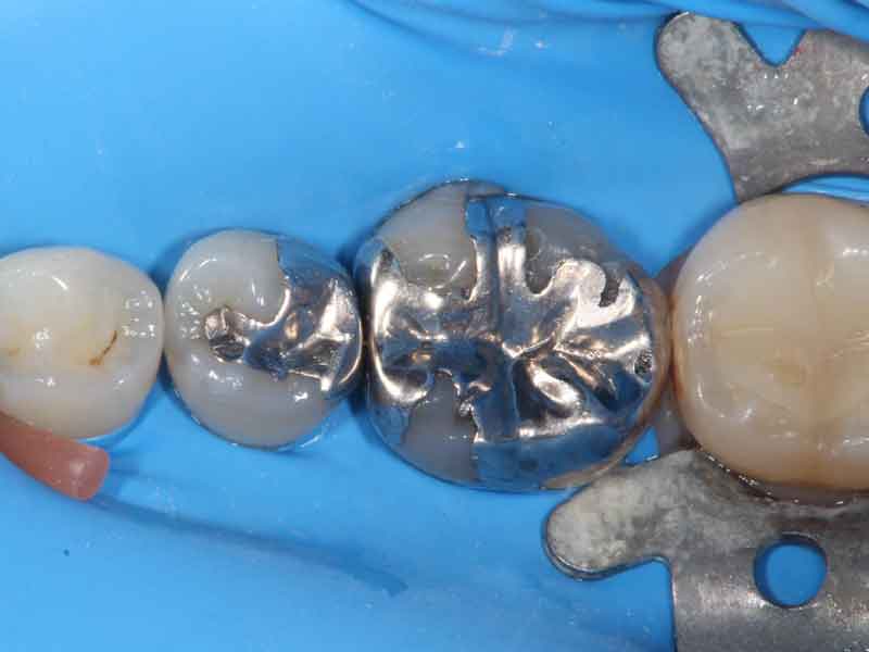 ラバーダムと呼ばれる青いシートとかけて、口腔内から治療を行う歯を隔離している写真