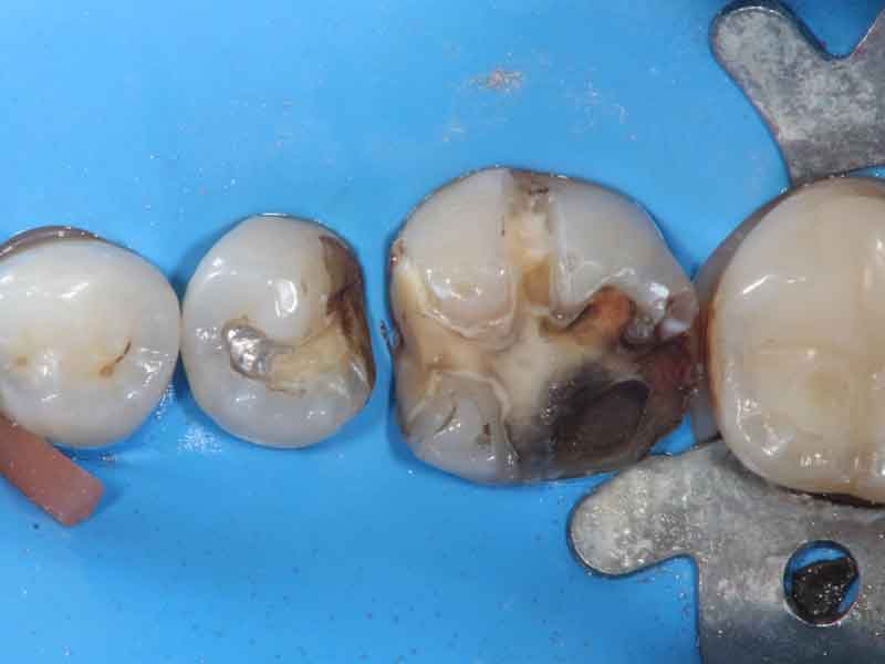 金属の被せ物を外した歯の写真。虫歯になっている。