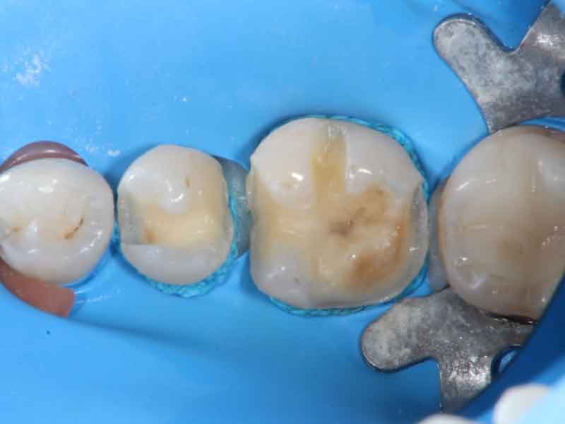 被せ物が装着できるように歯の形を形成した写真