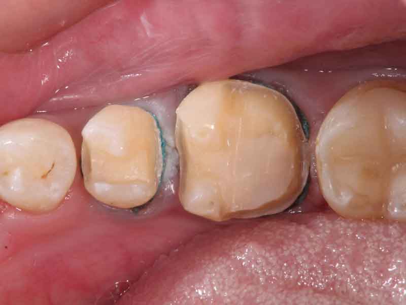 歯と歯茎の境目まで綺麗に型取りができるよう、歯と歯茎の境目に圧排糸と呼ばれる糸を入れた状態。