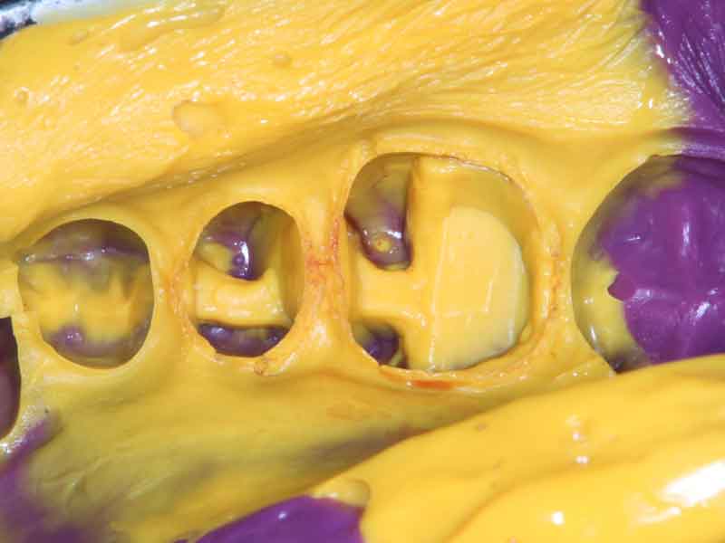 型取りを行ったシリコン印象剤の写真。歯と歯茎の境目まで詳細な型が取れている。