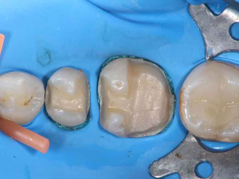 被せ物を装着するために、ラバーダムを装着して口腔内から歯を隔離している写真。