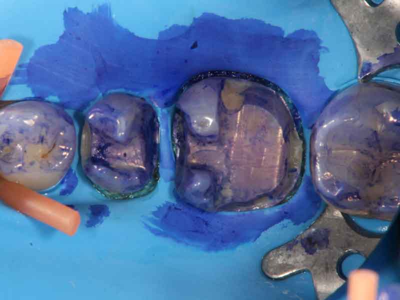 染め出しを歯に塗布した写真。