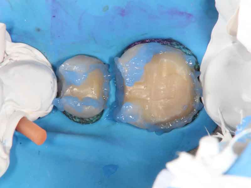 エッチングと呼ばれる材料を歯のエナメル質へ塗布している写真。