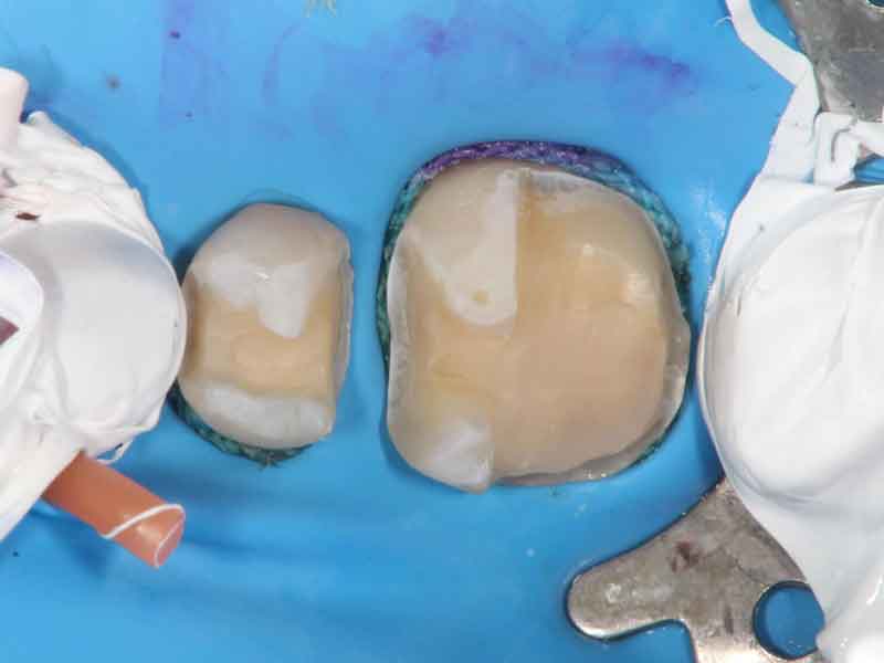 エッチングを水洗し、エアブロー乾燥させた歯の写真。エッチングを塗布した場所が白いすりガラス状になっている。