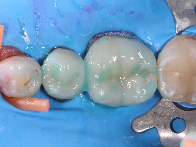 被せ物をレジンセメントで歯に装着し、オキシガードと呼ばれる酸素遮断剤を塗布した歯の写真。
