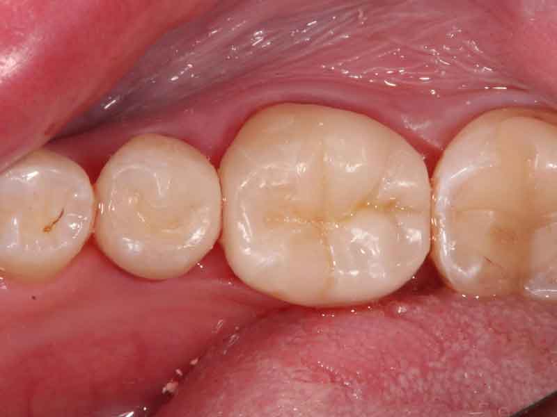 術後写真：セラミックが入った歯の写真