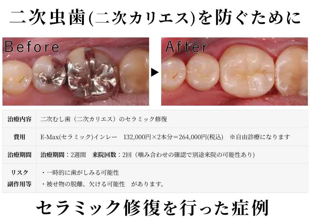 虫歯様 二次むし歯（二次カリエス）を防ぐためにセラミック治療を選択した20代