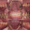 歯周病（歯槽膿漏 歯周炎）治療 口が臭いと周りに指摘されたり歯磨きのたびに歯茎から